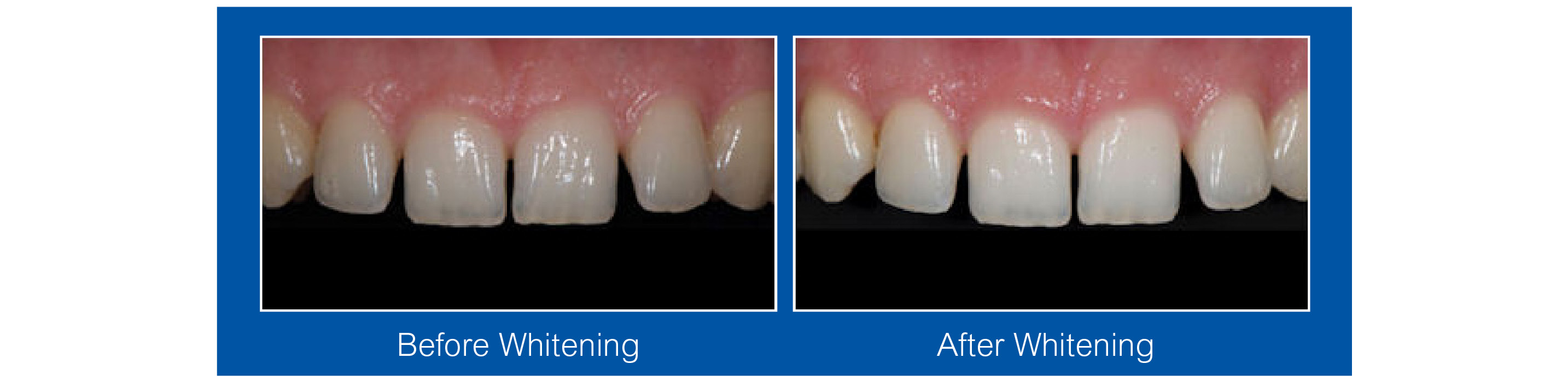 Teeth Whitening Waterloo